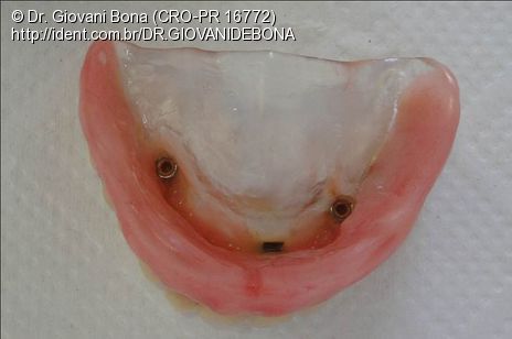 overdenture barra clip superior solu 231 227 o alternativa para protocolo superior flange overdenture barra clip superior solu 231 227 o alternativa para protocolo superior flange