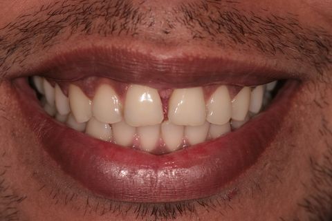 Foto inicial, já feita a cirurgia do freio labial