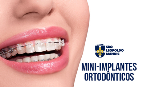 Imersão em Desmistificando e Descomplicando o Uso de Mini Implantes em Ortodontia (Intra e Extra Radiculares) (Mec) Cód.: 5070