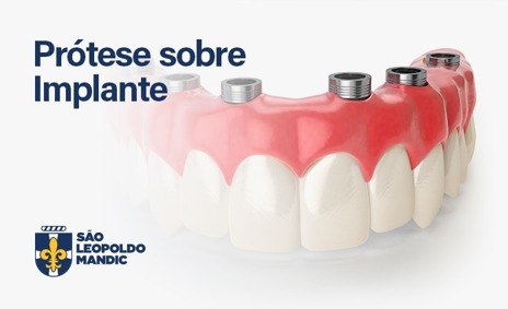 Capacitação em Prótese Sobre Implante (Mec) Cód.: 5044