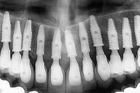 CURSO DE IMERSÃO EM CONE MORSE