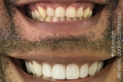 Antes e depois dos laminados cimentado. Antes e depois dos laminados cimentado.