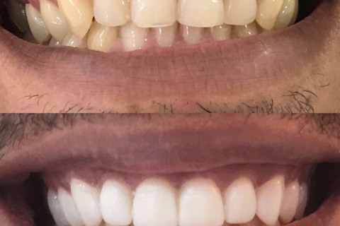 Provisórios com resina bisacrilica Provisórios com resina bisacrilica