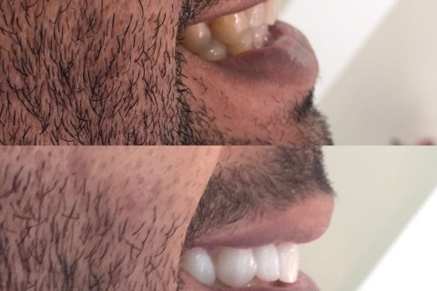 Comparação do suporte labial Comparação do suporte labial