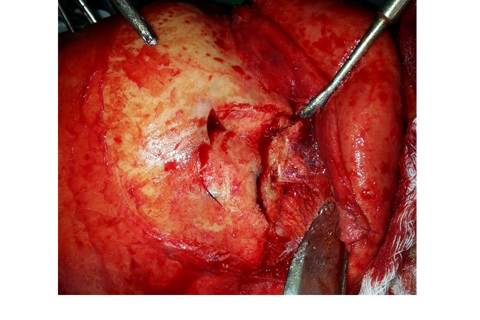 Transoperatório