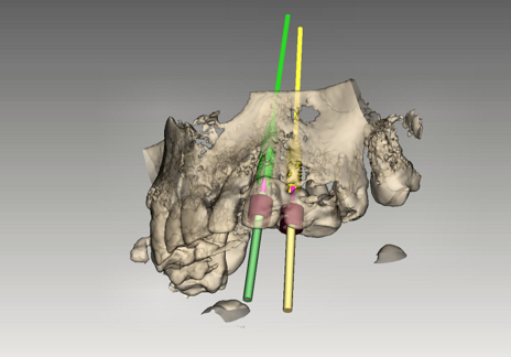 planejamento em implantes