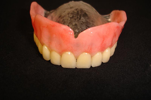 Prótese total superior confeccionada previamente à cirurgia.