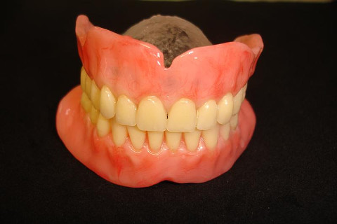 Vista frontal da prótese total superior e overdenture inferior.