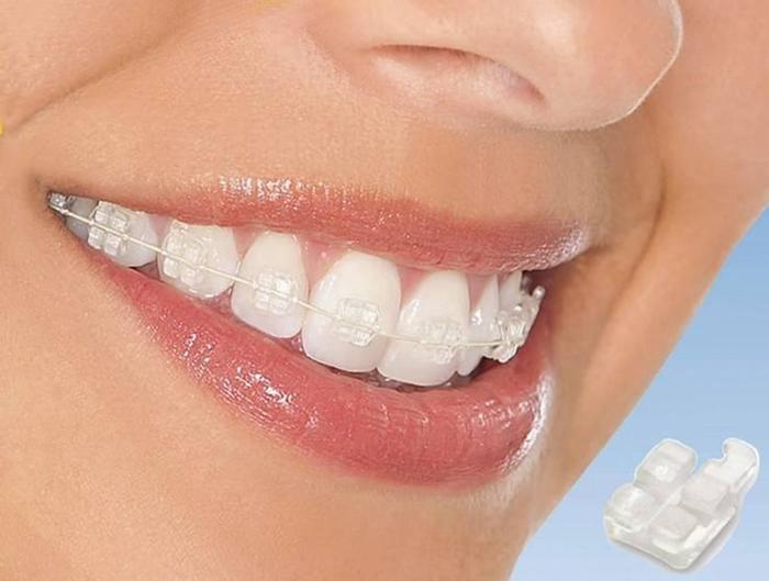 Brackets Estéticos Melhore seu Sorriso de Forma Imperceptível, Artigo