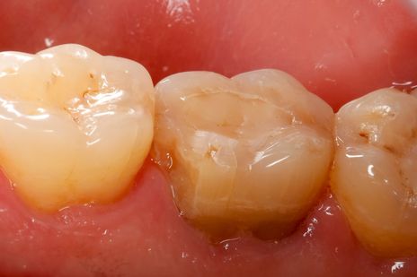 Como uma Restauração Classe Ii Difícil Se Torna Fácil Utilizando um ...