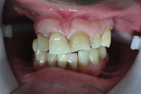 Aspecto Inicial (Percebe-se desgaste excessivo da face vestibular e deslocamento do elemento 11)