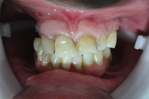 Aspecto Inicial (Percebe-se desgaste excessivo da face vestibular e deslocamento do elemento 11)