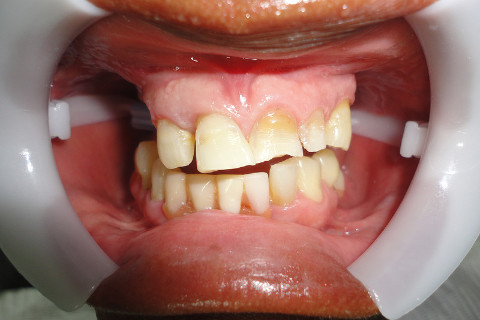 Aspecto Inicial (Percebe-se desgaste excessivo da face vestibular e deslocamento do elemento 11)