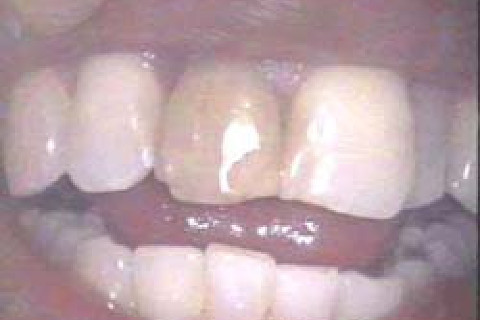 Antes Antes