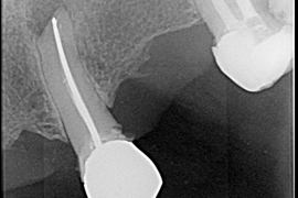 Microcirurgia Endodôntica como Tratamento Complementar de um Retratamento Endodôntico de Canais com Obturação de Cones de Prata