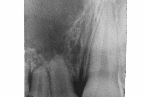 Rx periapical