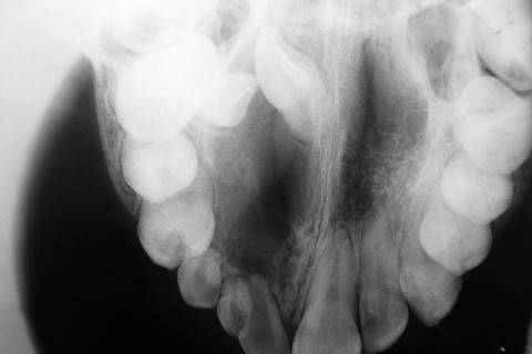 Rx oclusal