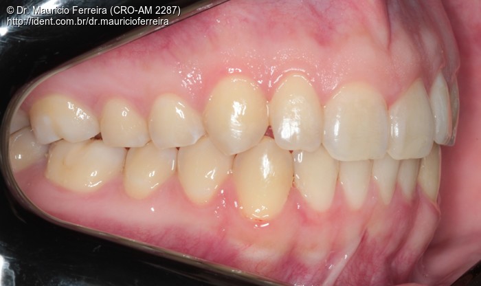 Uso do Aparelho Invisalign no Tratamento da Má Oclusão de Classe Ii ...