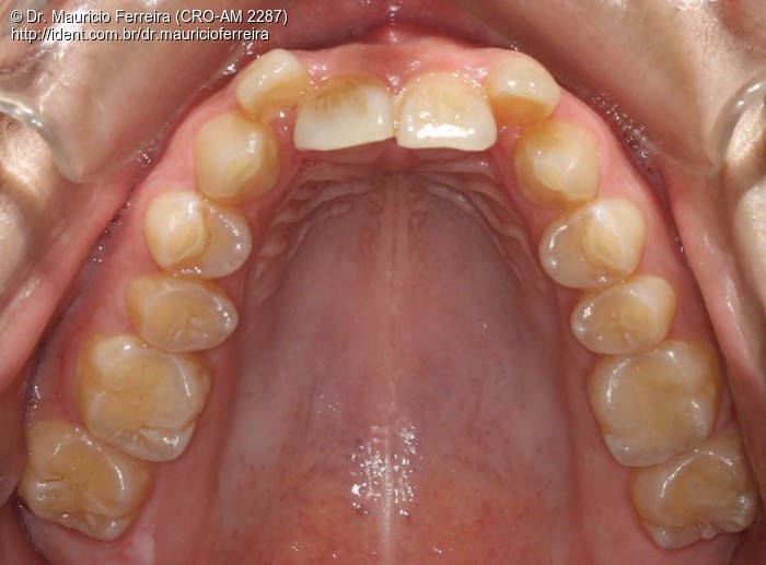 Uso do Aparelho Invisalign no Tratamento da Má Oclusão de Classe Ii ...