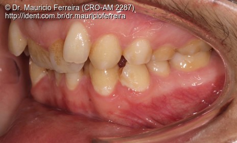 Uso do Aparelho Invisalign no Tratamento da Má Oclusão de Classe Ii ...