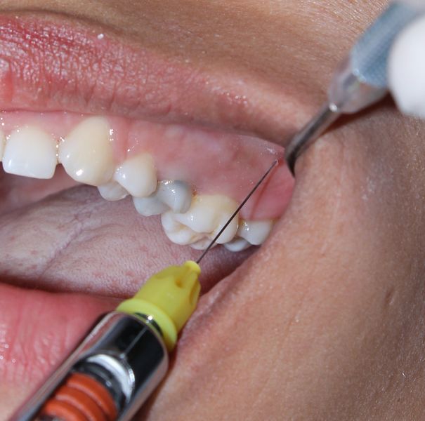 Restauração com Resina Composta Classe I Dente 1.7, Caso clínico iDent Restauração com Resina Composta Classe I Dente 1.7, Caso clínico iDent