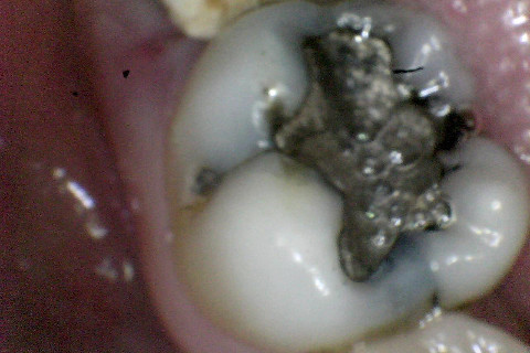 Antes Antes