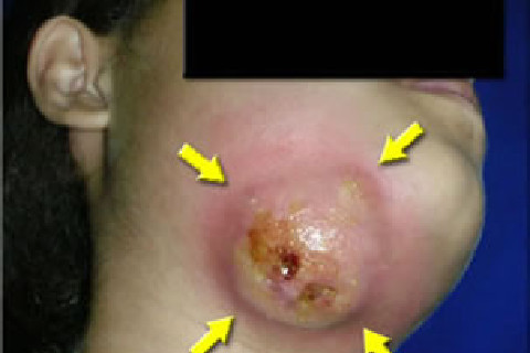 Infecção bacteriana Infecção bacteriana