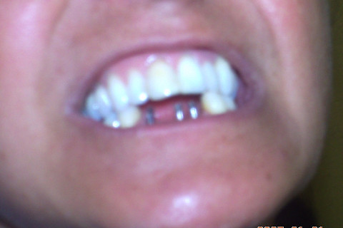 Implantes de carga imediata instalados e a visão do paciente sem os elementos inferiores, como era antes do trabalho. Paciente relatou perda de qualidade de vida, visto que nem saia mais de casa por vergonha de sua boca. Implantes de carga imediata instalados e a visão do paciente sem os elementos inferiores, como era antes do trabalho. Paciente relatou perda de qualidade de vida, visto que nem saia mais de casa por vergonha de sua boca.
