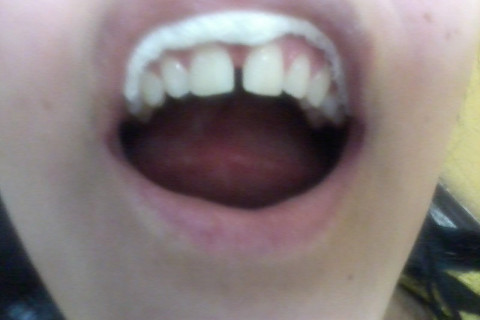 Diastema grande e paciente em busca de resultado imediato. Diastema grande e paciente em busca de resultado imediato.