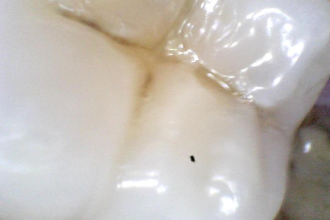 Depois. Dente já recuperado sem tratar o canal Depois. Dente já recuperado sem tratar o canal
