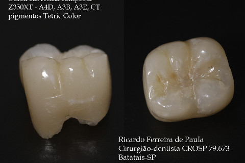 Feita por mim mesmo com as resinas descritas na foto, jateada com óxido de alumínio e cimentada com cimento resinoso dual autoadesivo SET. Feita por mim mesmo com as resinas descritas na foto, jateada com óxido de alumínio e cimentada com cimento resinoso dual autoadesivo SET.