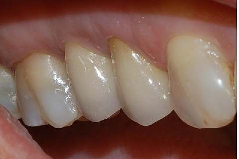 Segundo pré-molar sobre implante instalado com a técnica de elevação minimamente traumática de seio maxilar Segundo pré-molar sobre implante instalado com a técnica de elevação minimamente traumática de seio maxilar