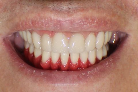 Prova dos dentes