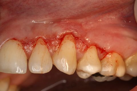 Incisões feitas na base da papila